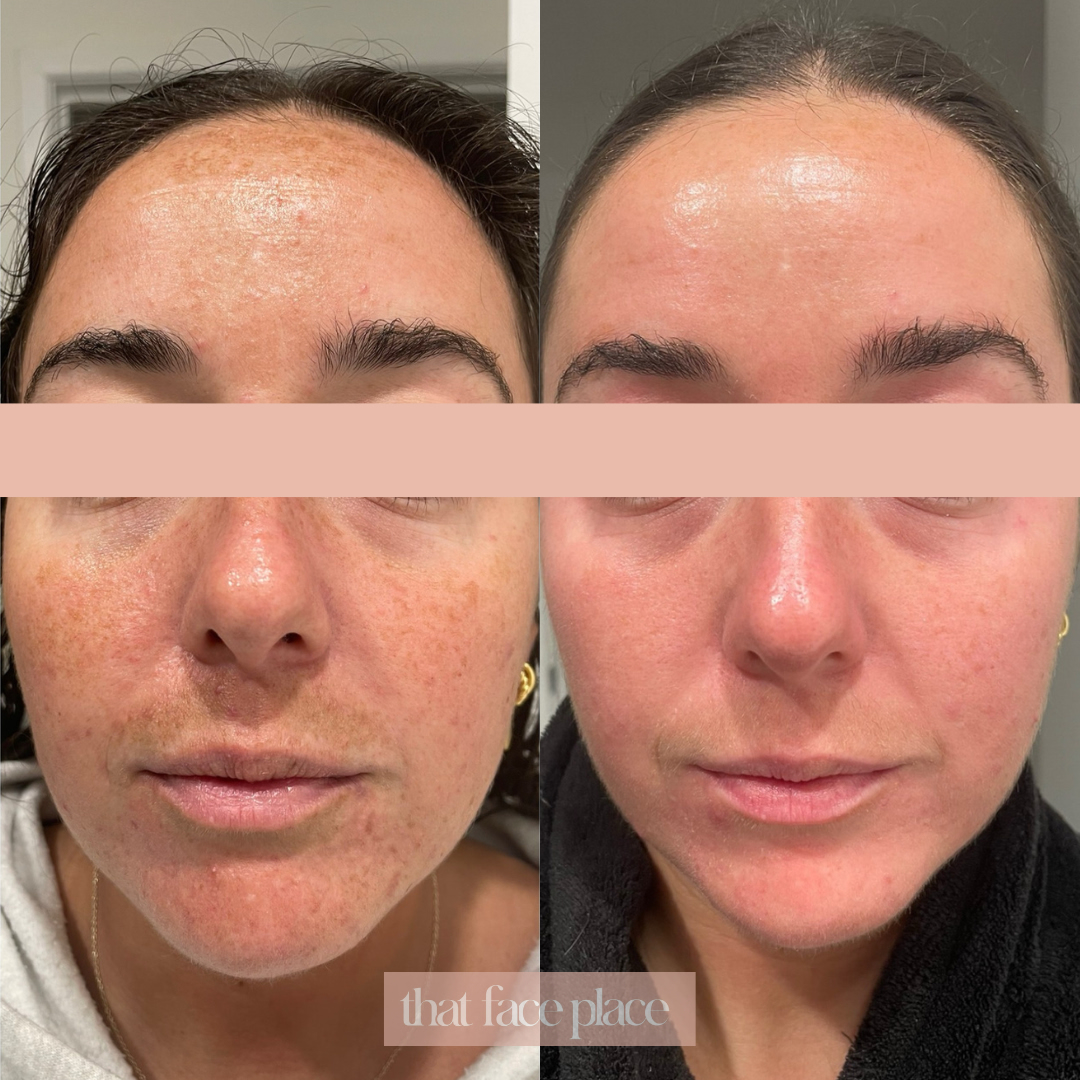 Before and after comparison of a pigmentation skin treatment result