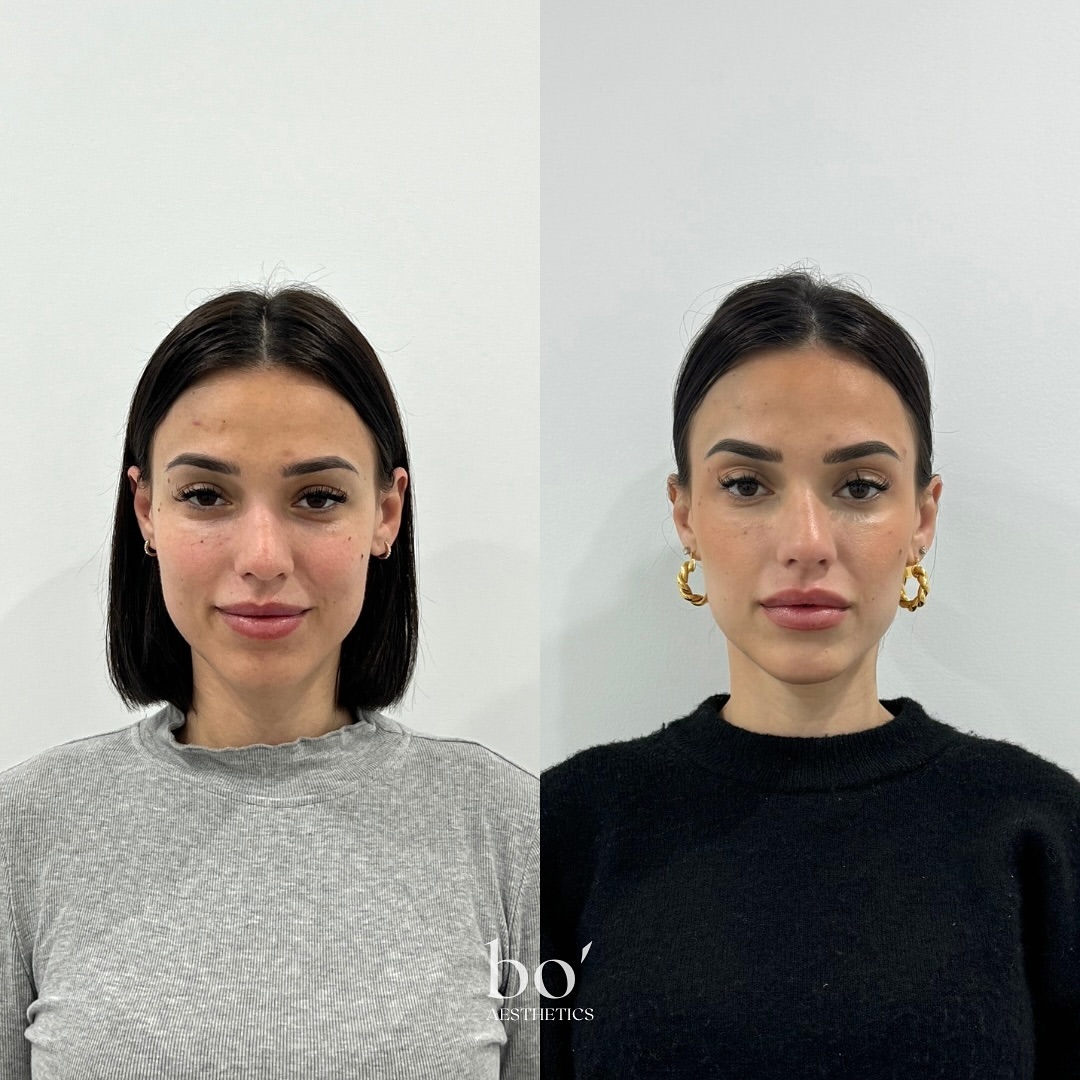 Before and after comparison of a subtle lip enhancement result