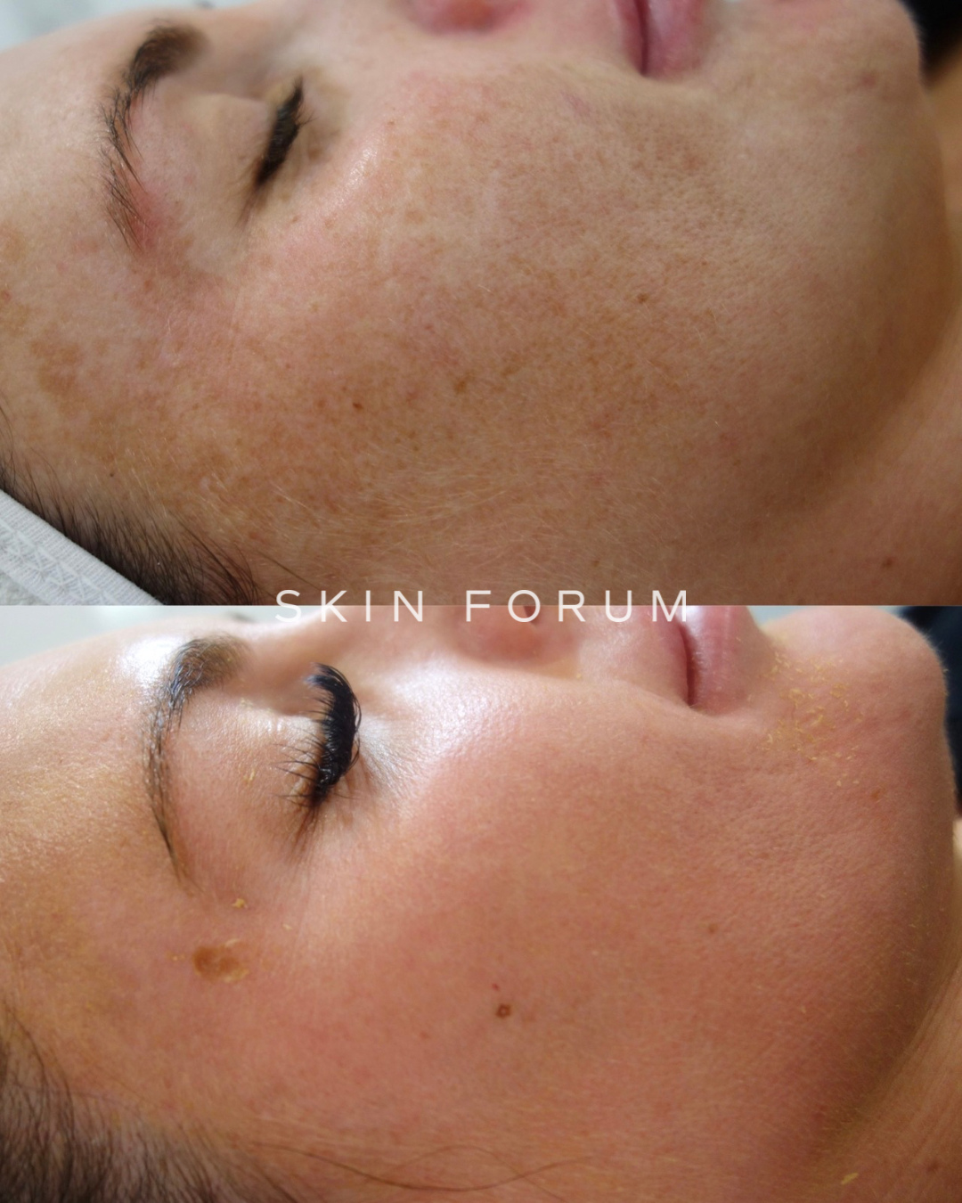 Before and after comparison of a skin treatment result