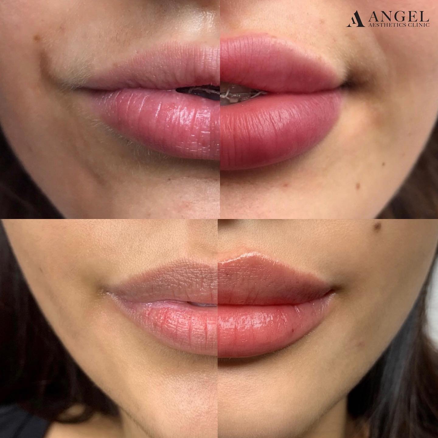 Before and after comparison of lip enhancement treatment results